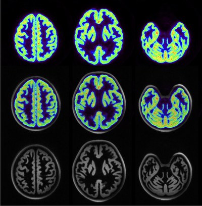 Simultaneous PET and MR images taken with FZJ's BrainPET in a Siemens 7T MRT